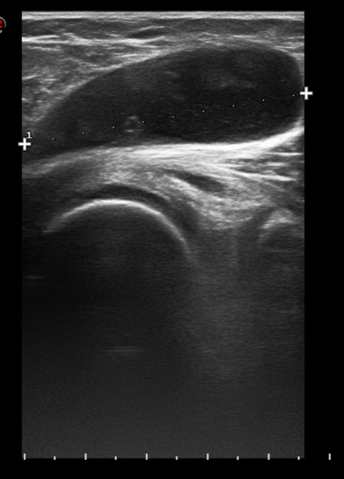 Radiology Station Bakers Cyst