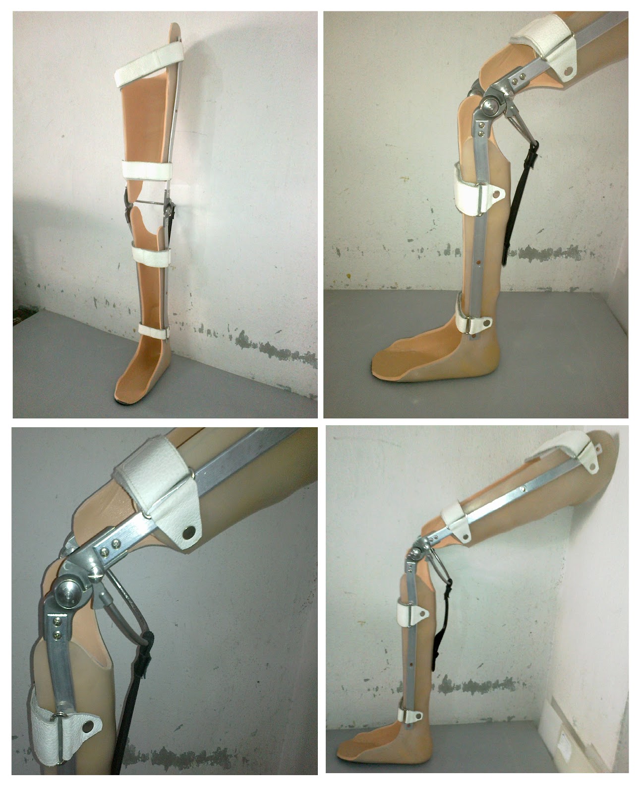 Prosthetics & Orthotics from My Care Calipers for Polio Patients (KAFO)