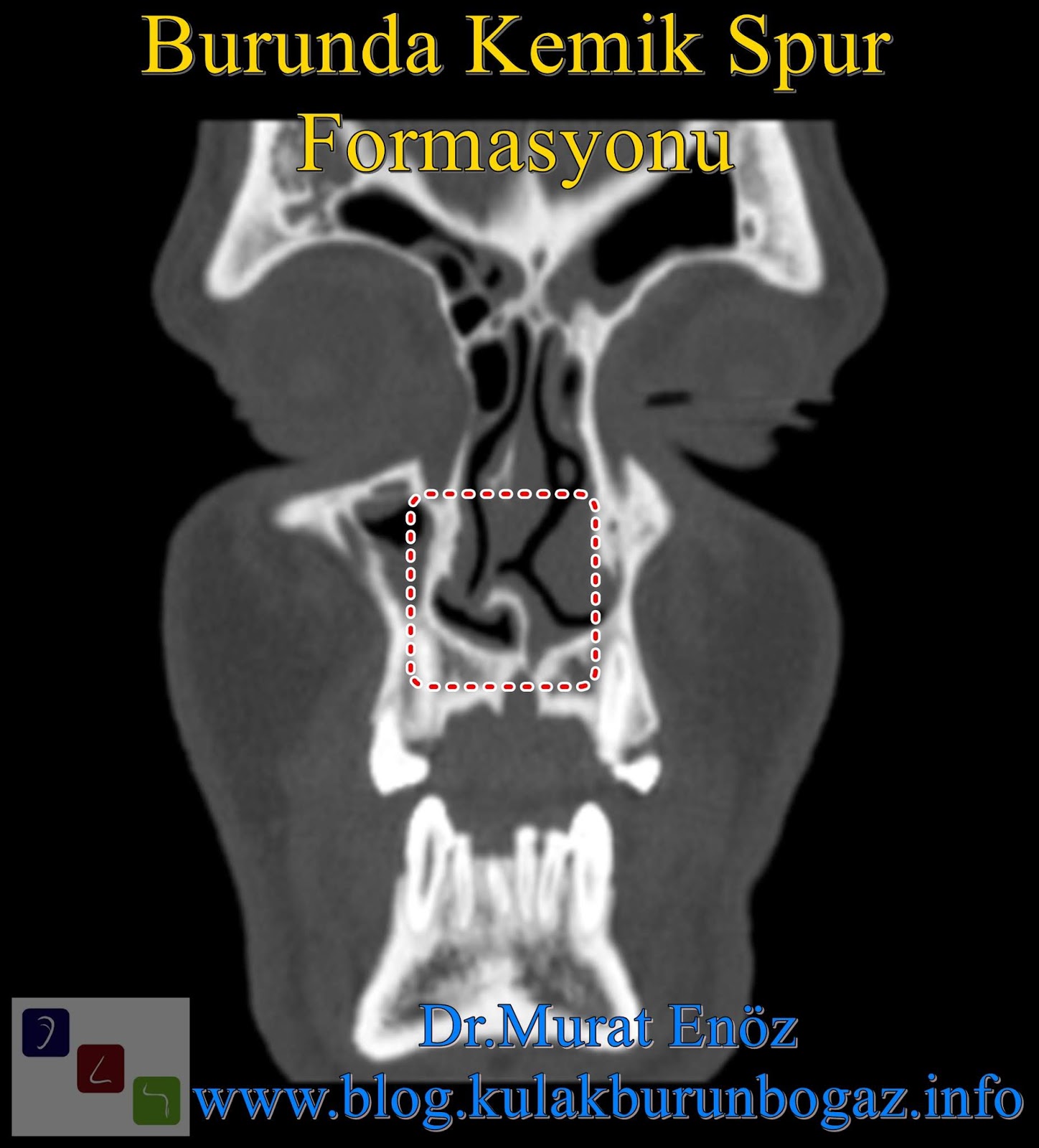 Ossified Overhang (Osteophyte) In The Nose That Can Cause Atypical