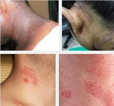 Ahlinya Obat Gatal Ahlinya Obat Gatal