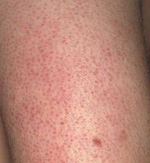 David Robles Md Phd Dermatologist Keratosis Pilaris Bumpy Skin On The Arms By David Robles Md Phd
