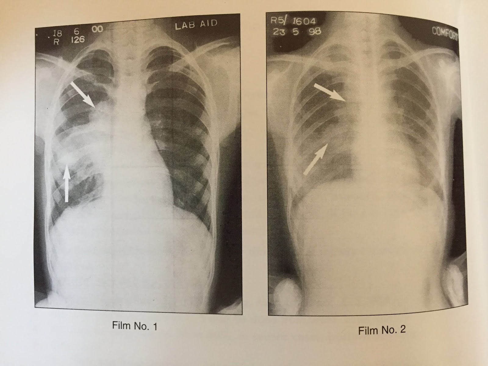 XRAYS OF PRIMARY TUBERCULOSIS
