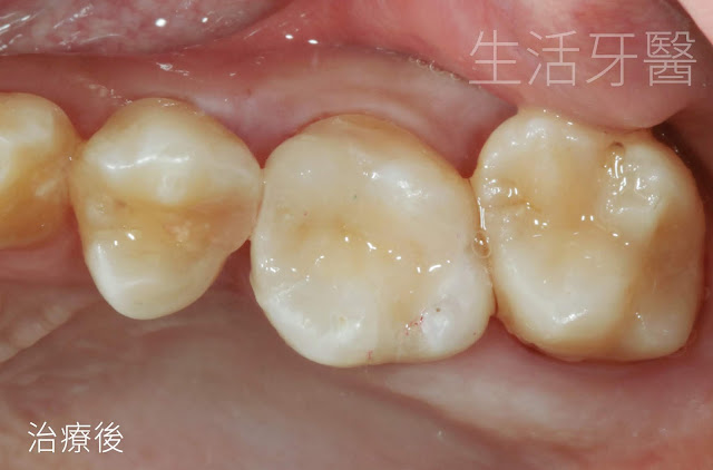 台中牙醫陶瓷補牙推薦，蛀牙補牙