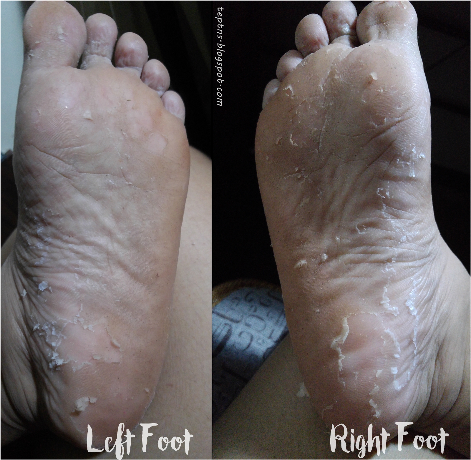 Purederm's Exfoliating Foot Mask Review Tep Tries New Stuff