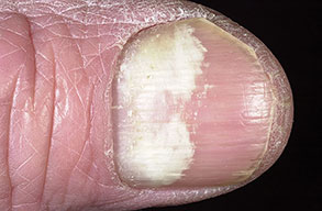Study Medical Photos: Fungal Infection of Nails