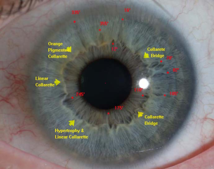 Modern & Multidimensional Iridology Double Lacunae at 70', Time Risk