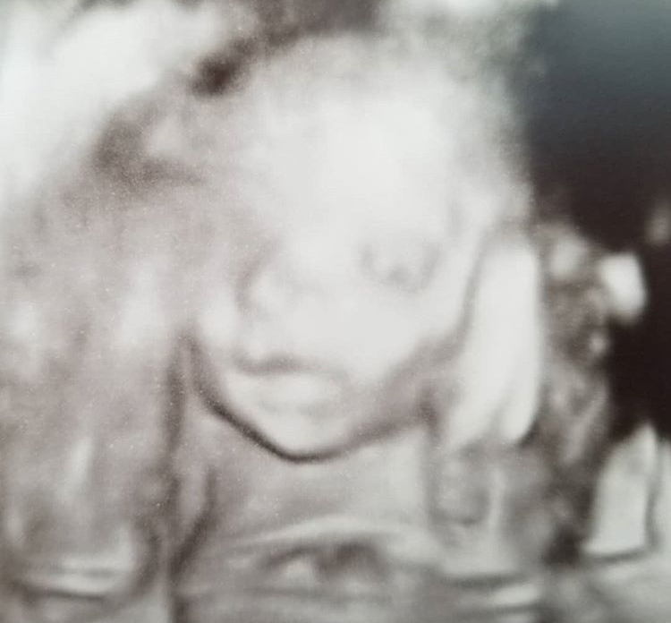 24 Haftalık Gebelik Ultrason Görüntüleri, Hareketleri