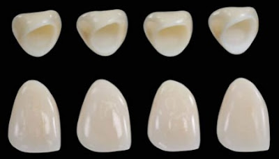 Răng sứ titan có tốt đối với cơ thể con người không?
