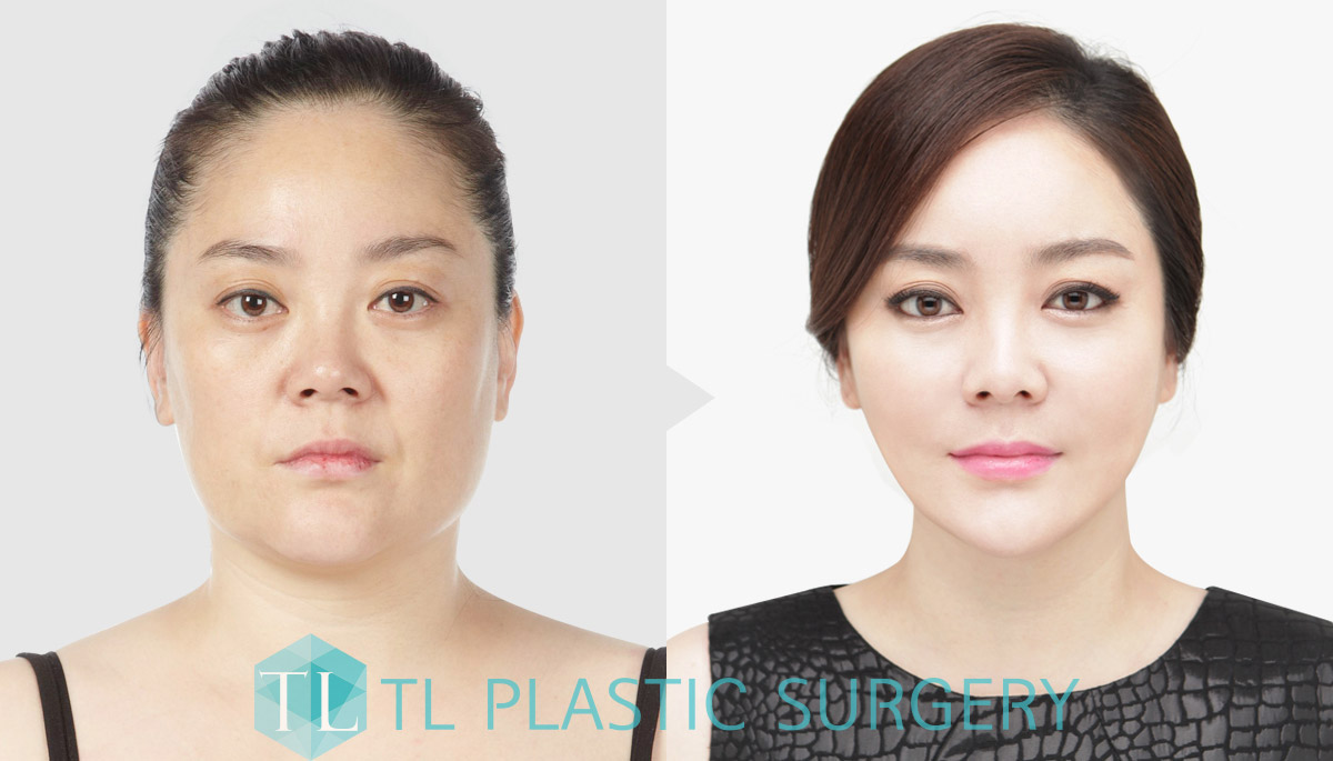 Buccal Fat Removal! TL Dr Jung YeonHo TL ANTIAGING LIFTING KOREA