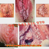 Obat Kutil Kelamin Obat Kutil Kelamin