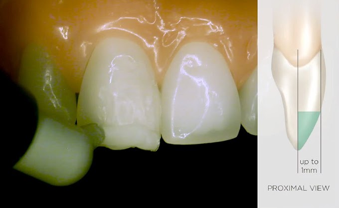 DENTAL MATERIALS: TPH Spectra ST® Effects Composite Helps Simplify Demanding Anterior Cases - Dentsply Sirona