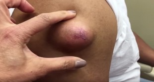 bulto muy pequeño en el brazo