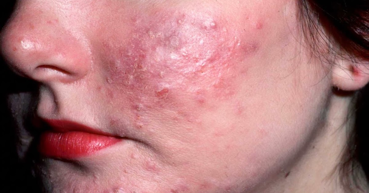 Study Medical Photos A Brief Description Of Acne Rosacea