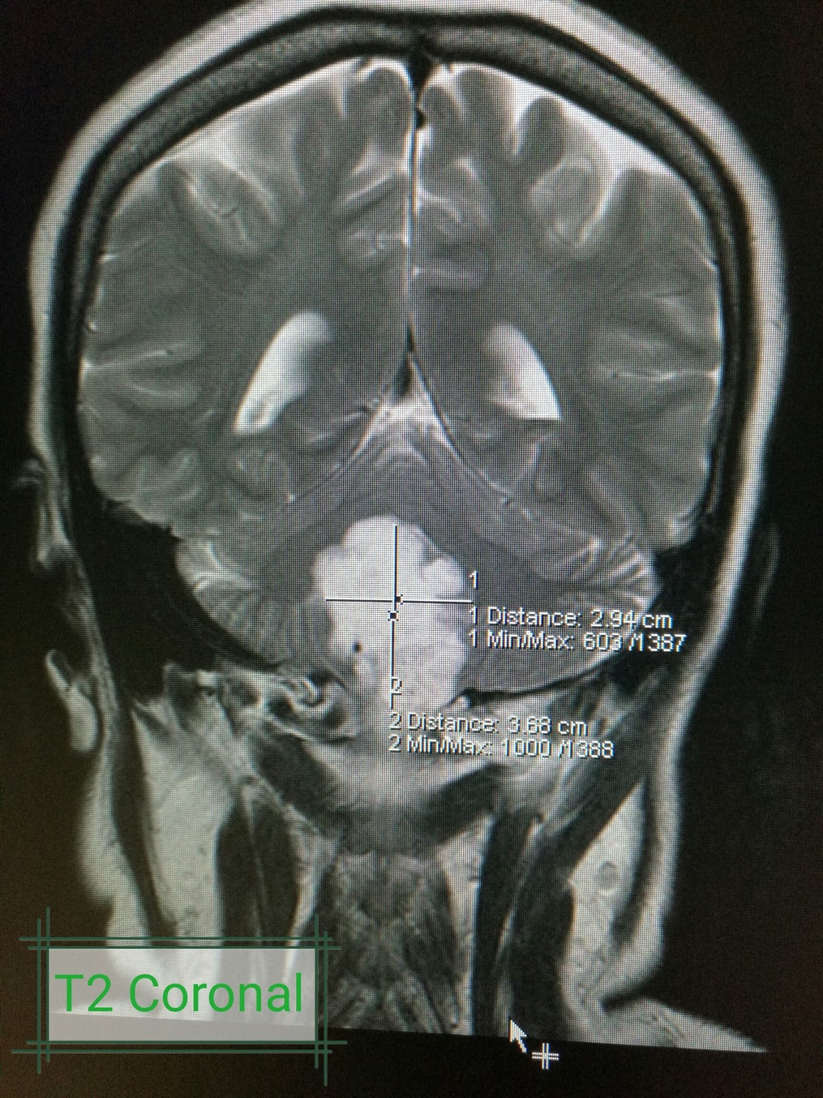 Brain Tumor / Cancer MR Imaging of the Brain RadTechOnDuty