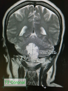 Brain tumor