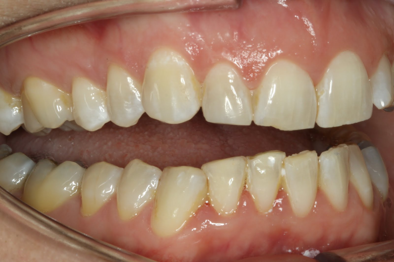 Talking Dentistry with Dr.Lotardo At Nesconset Dental BEFORE AND AFTER