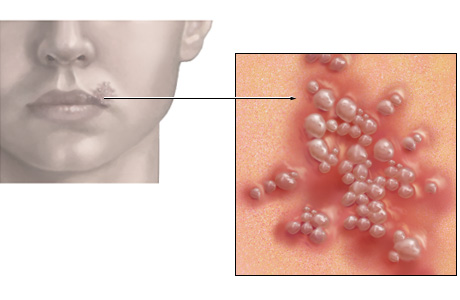 Cold sore-type blisters that