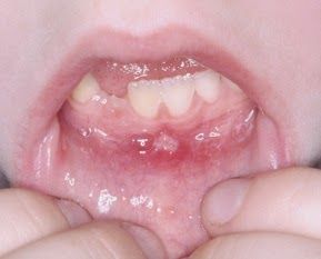 mouth_ulcer