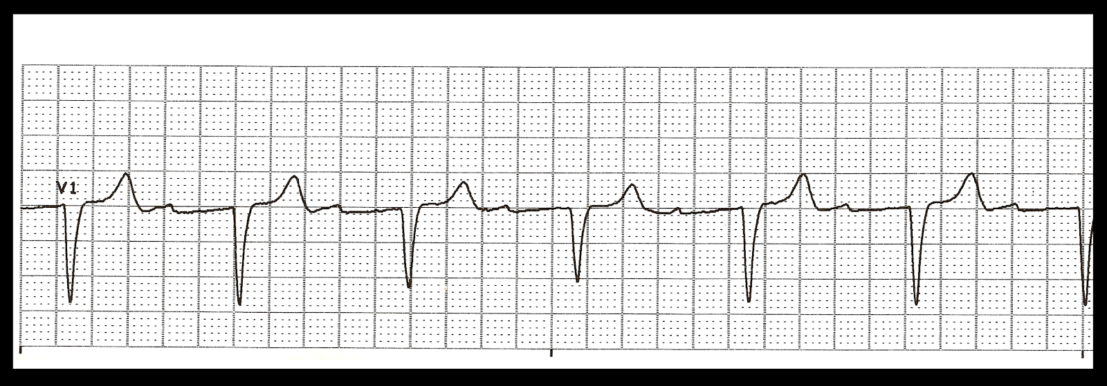 Various First Degree Heart Blocks