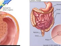 Symptoms and Causes of Colon-Rectal or Bowel Cancer