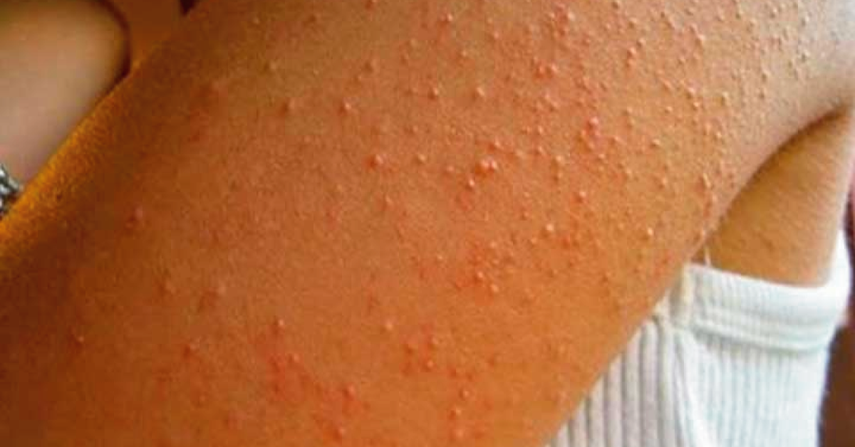 ¿Tienes estos granitos en el brazo? Mira por qué salen y cómo