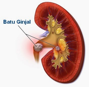 https://3.bp.blogspot.com/-IUow5W9YBRo/WQA7GuAzi3I/AAAAAAAAAO0/-IFlOBasLu07IMMF9FsWSAExEutYD8MPgCLcB/s1600/batu-ginjal-dan-pengobatannya.jpg