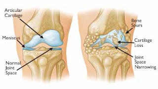 cara menyembuhkan osteoarthritis