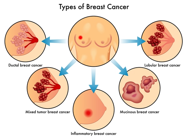 What are the symptoms of stage 3 breast cancer?