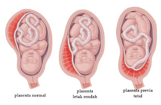 gejala placenta previa