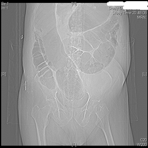 Docencia Alto Palancia Sindrome de Ogilvie