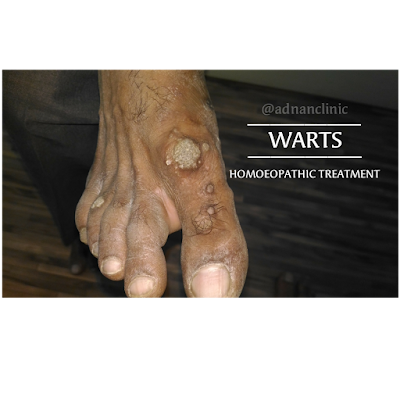 Warts homoeopathic