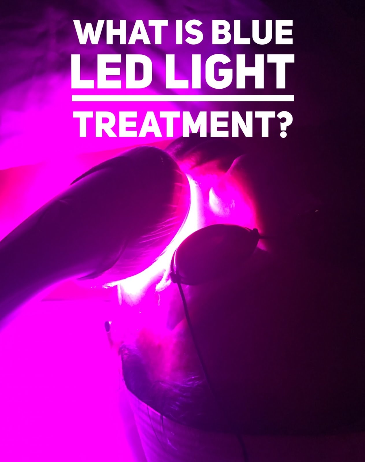 Defaced Blue LED light for acne