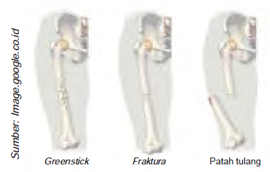 Penyakit Pada Sendi, Otot, Tulang & Tulang Belakang ...