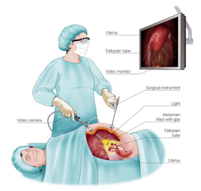 endo pain location endo pain location
