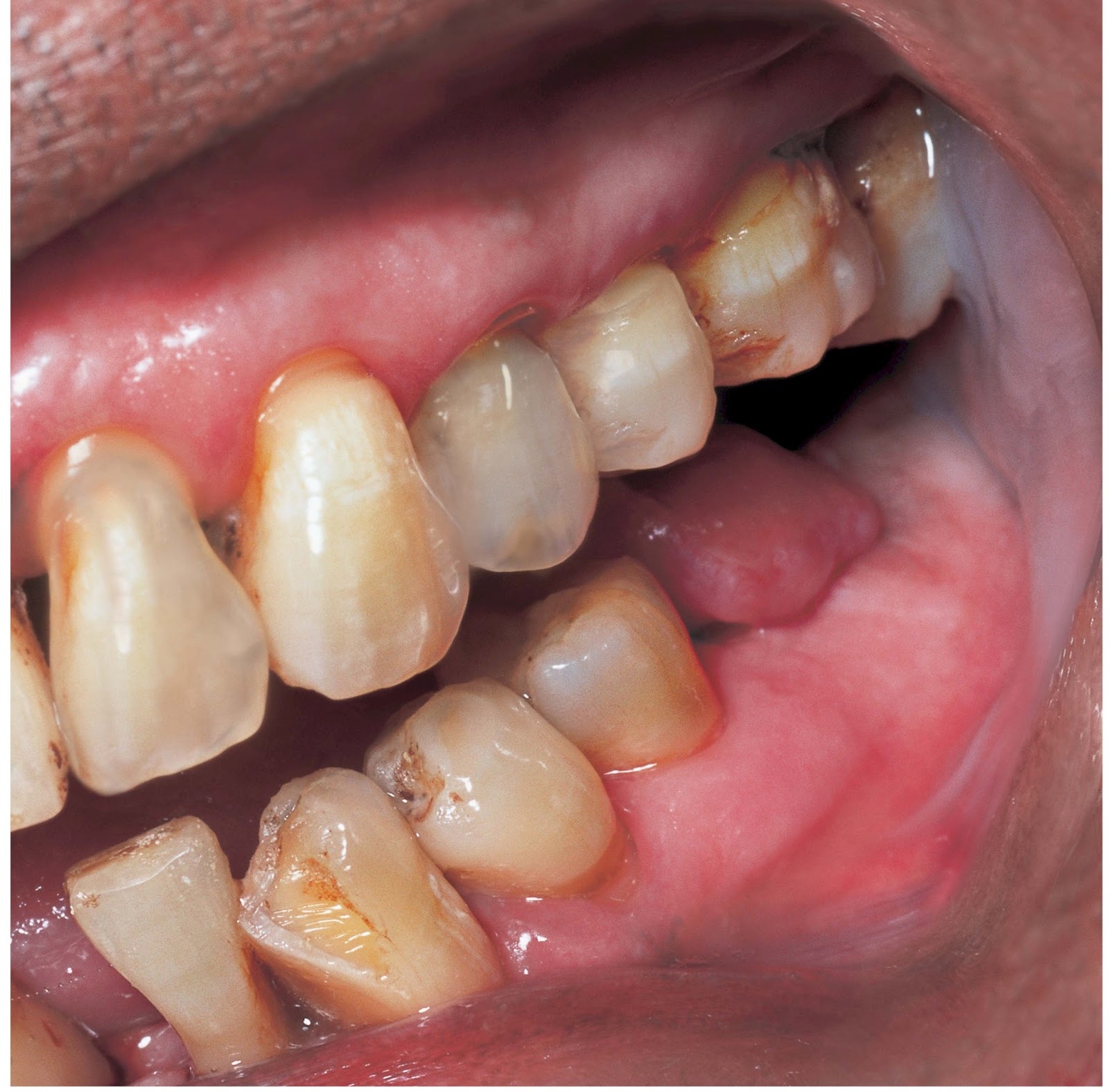 Dr. Robert G. Tupac Prosthodontics Smoking and Tooth Loss