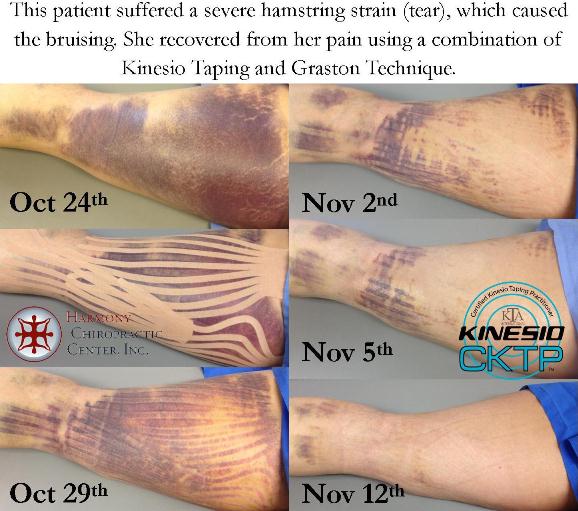 don-t-pin-that-banana-peels-to-heal-bruises