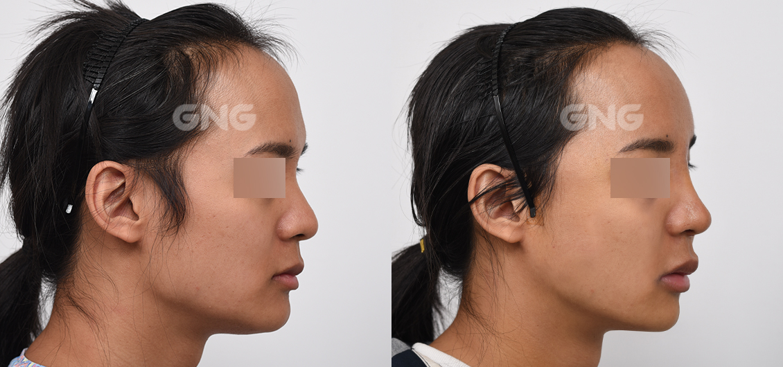 GNG Plastic Surgery Hospital Full Face Fat Graft