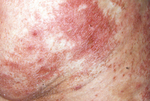 Red Scaly Rash On Legs - Doctor answers on HealthTap