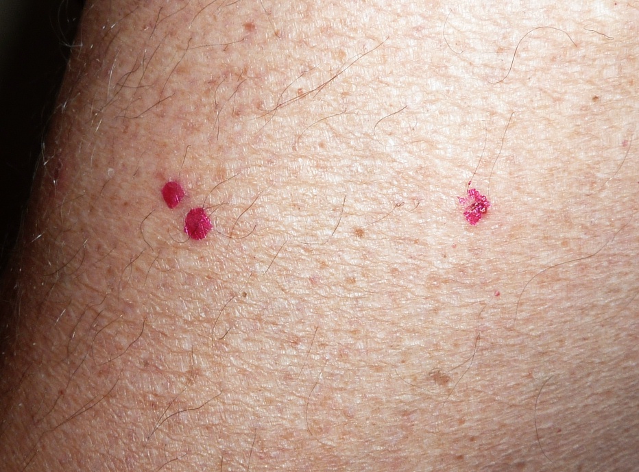 Flea Bites: Pictures, Symptoms, Treatment and Prevention