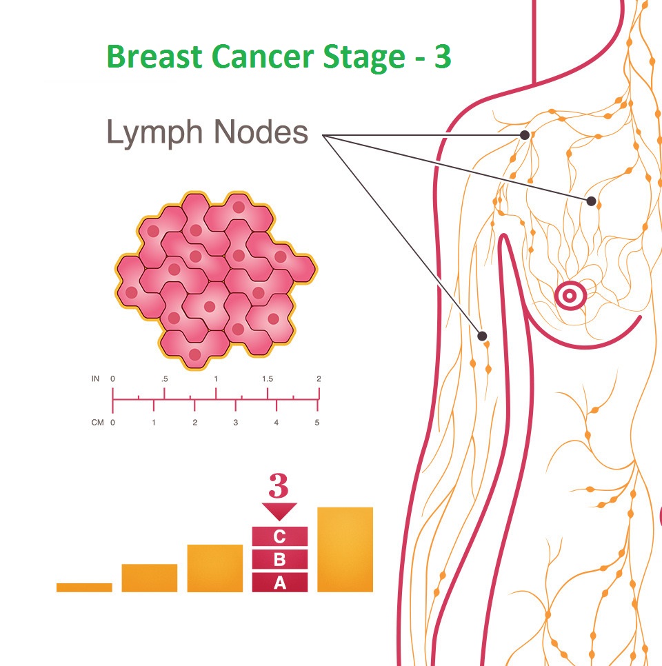 Breast cancer stage - 3 Breast cancer stage - 3