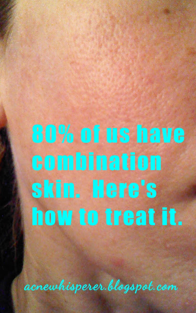dealing with combination skin in Adult Acne