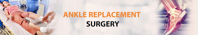 Guide to Ankle Replacement Surgery