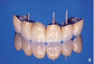 Conceptions des bridges dentaires en fonction du type d’ancrage (connexion prothèse/piliers)