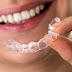 Niềng răng trong suốt invisalign bằng khay nhựa