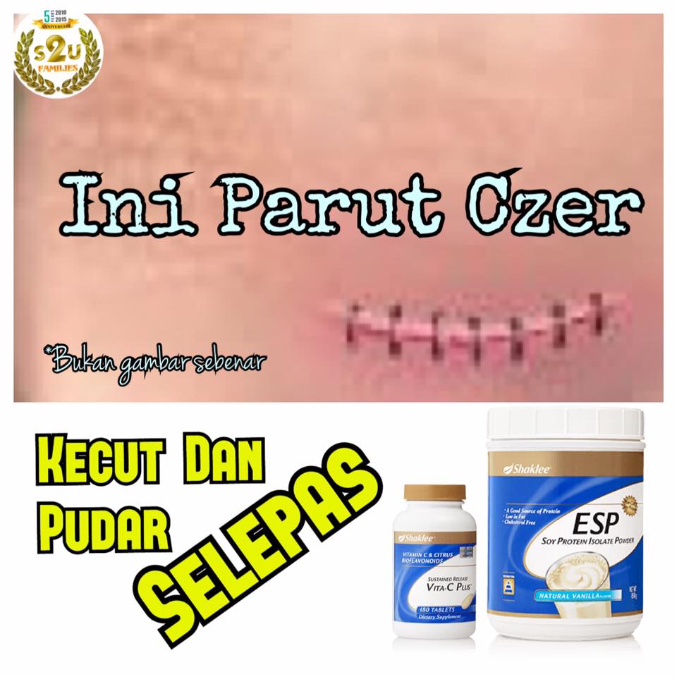 Luka Czer Cepat Kecut dan Pudar Umi Nazrah