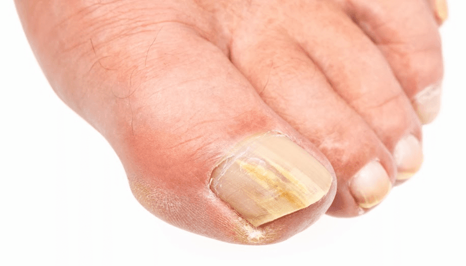 When rectal yeast infection 2016! Can yeast infections spread