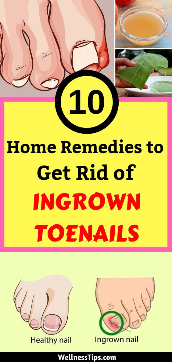 10 Home Remedies to Get Rid of Ingrown Toenails Stylelos