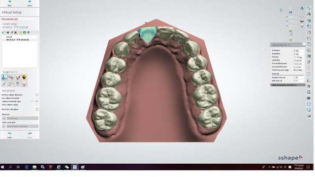 數位隱形矯正，牙齒矯正設計軟體
