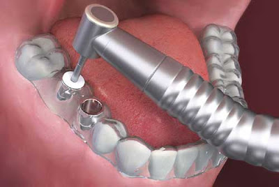 trong-rang-implant-co-dau-khong