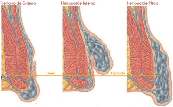 Hemorroides externas sangrantes en el embarazo